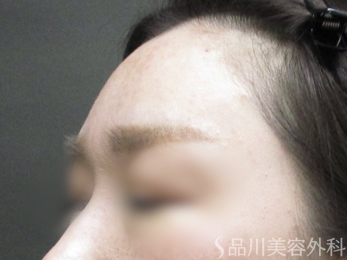 症例NO.65387のAFTER写真