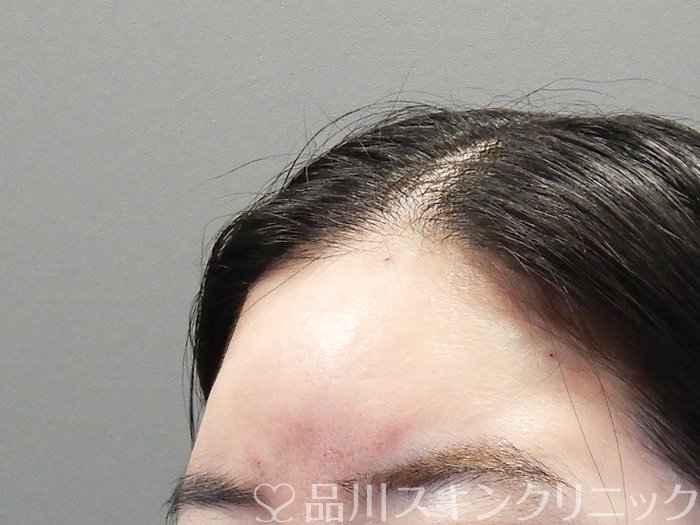 症例NO.72790のAFTER写真