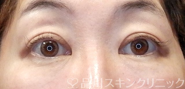 症例NO.67658のAFTER写真