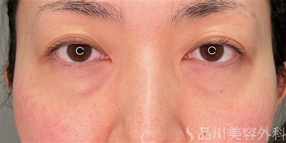症例NO.54606のBEFORE写真