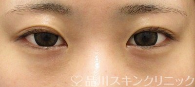 症例NO.65600のBEFORE写真