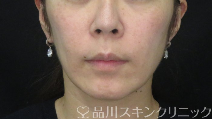 症例NO.72330のAFTER写真