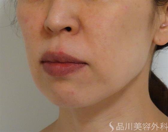 症例NO.42297のBEFORE写真