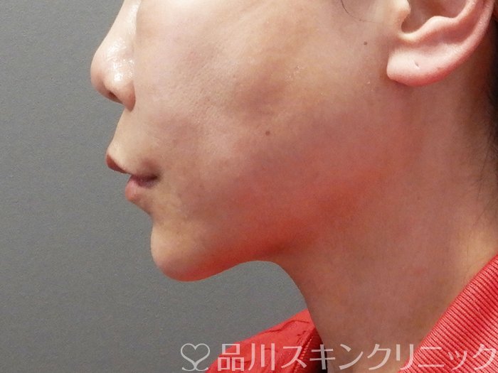 症例NO.72812のBEFORE写真