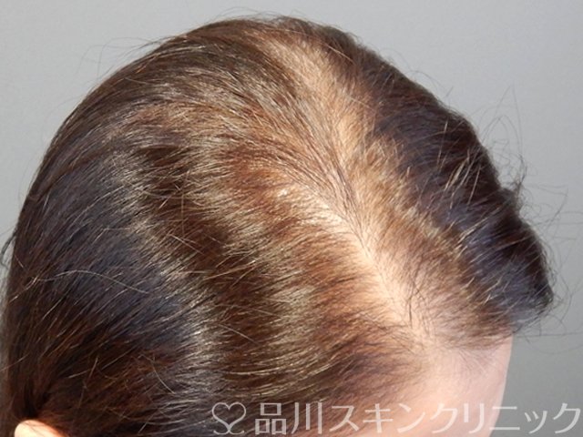 症例NO.69316のBEFORE写真