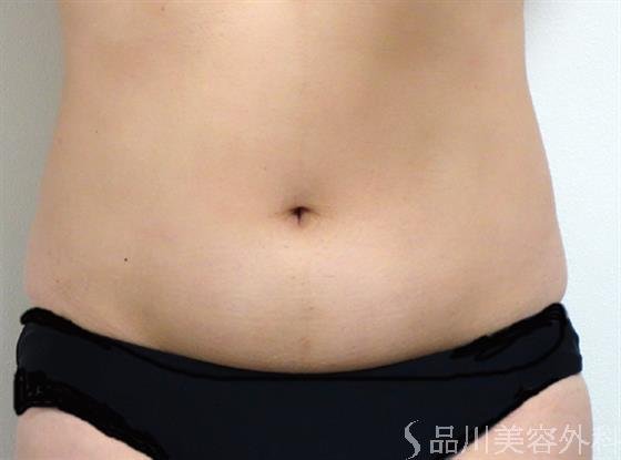 症例NO.35165のBEFORE写真