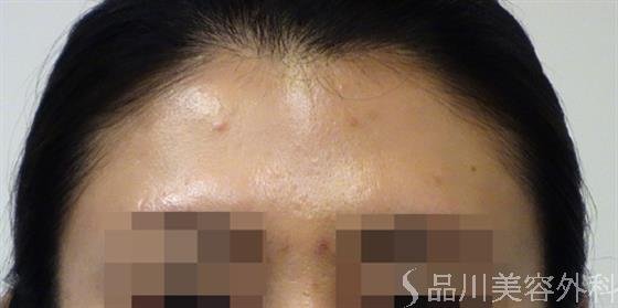 症例NO.47181のBEFORE写真