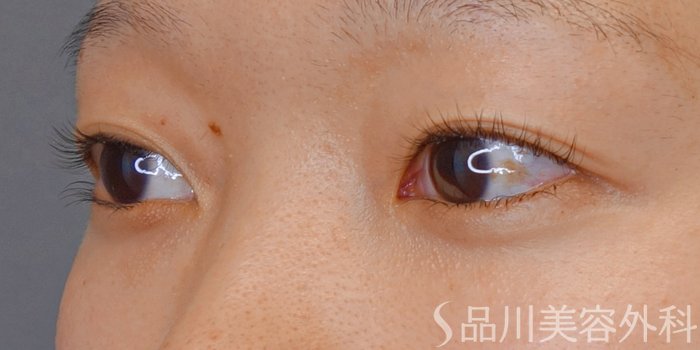 症例NO.72168のBEFORE写真