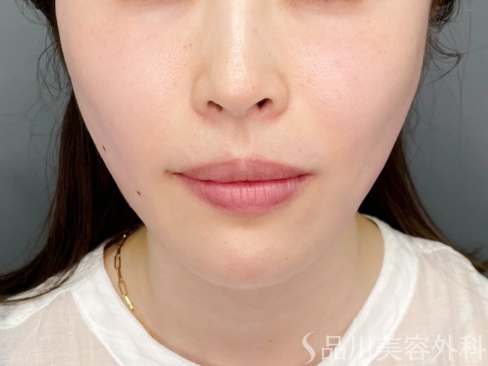 症例NO.73647のAFTER写真