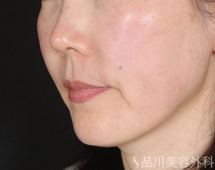 症例NO.73273のBEFORE写真