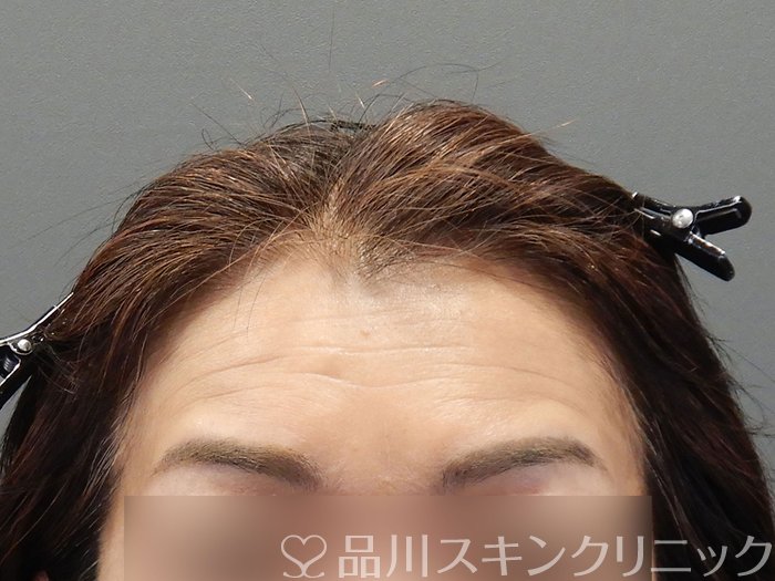 症例NO.72652のBEFORE写真