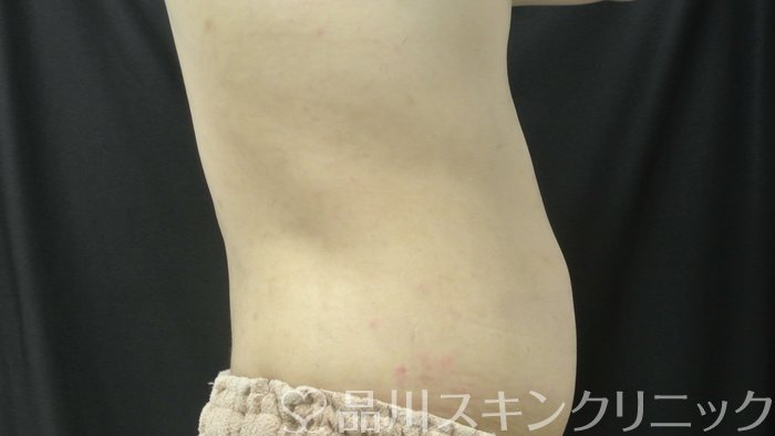 症例NO.71099のAFTER写真