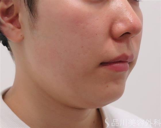 症例NO.45480のBEFORE写真