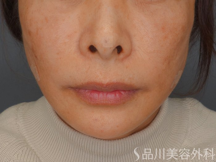 症例NO.73431のAFTER写真