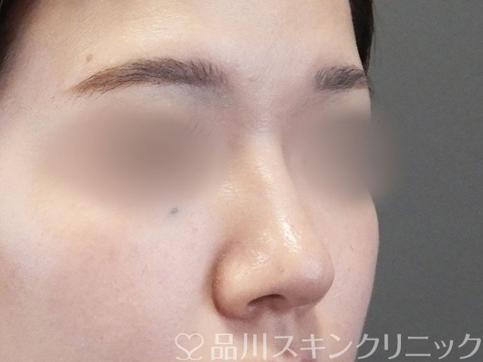 症例NO.65584のAFTER写真