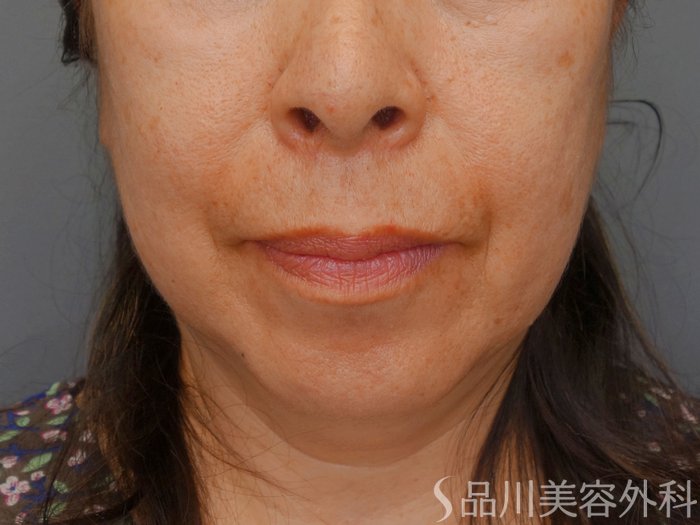 症例NO.65710のBEFORE写真