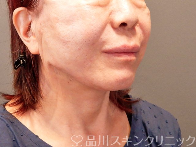 症例NO.71190のAFTER写真