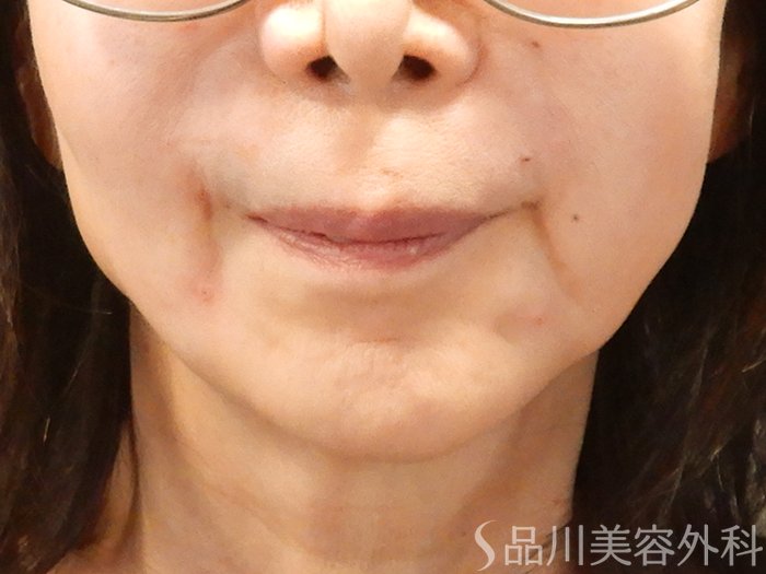 症例NO.71623のAFTER写真