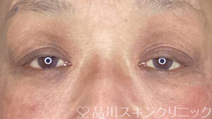 症例NO.71421のBEFORE写真