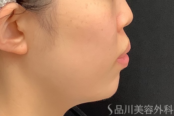 症例NO.71585のAFTER写真