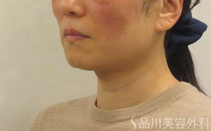 症例NO.72089のAFTER写真