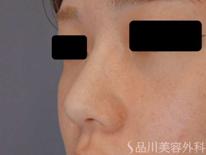 症例NO.72184のAFTER写真