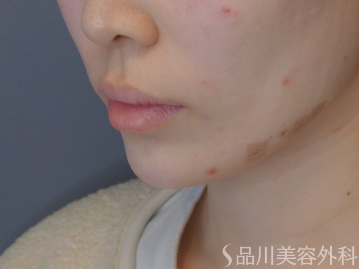 症例NO.72317のAFTER写真