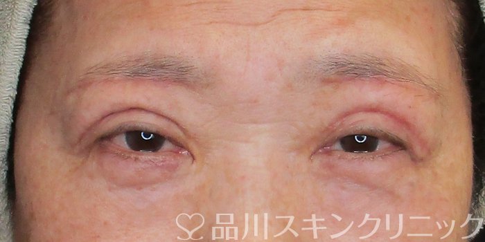 症例NO.74739のAFTER写真