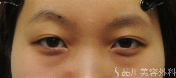 症例NO.19456のBEFORE写真