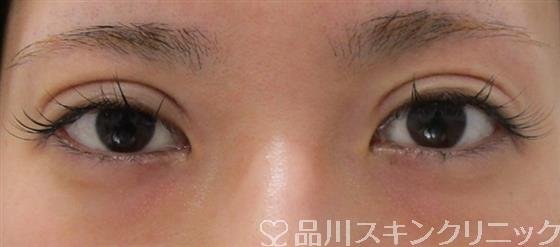 症例NO.38478のAFTER写真
