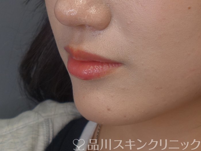 症例NO.74477のBEFORE写真