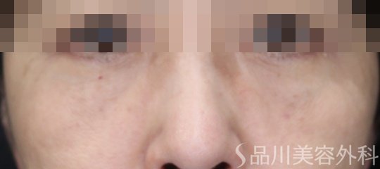 症例NO.70515のAFTER写真