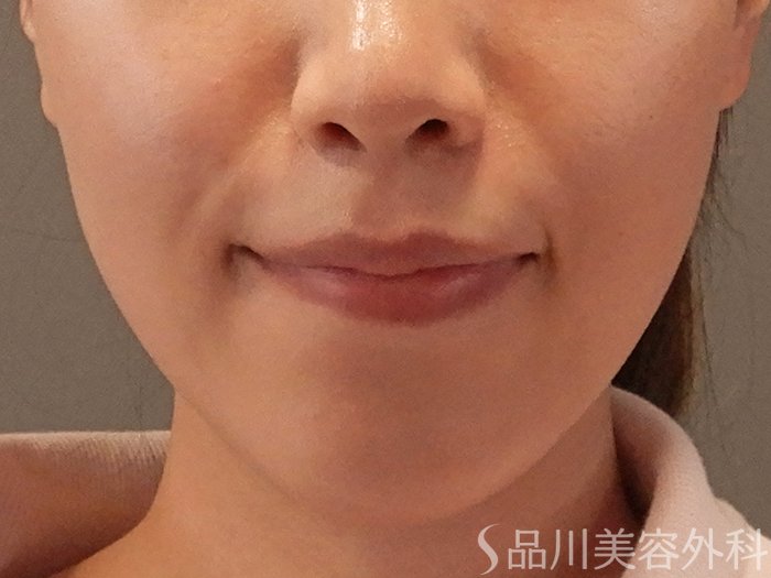 症例NO.70050のBEFORE写真