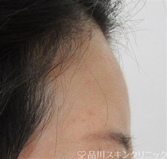 症例NO.42337のAFTER写真