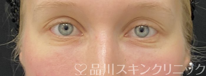 症例NO.75038のAFTER写真
