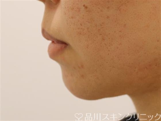 症例NO.43094のBEFORE写真