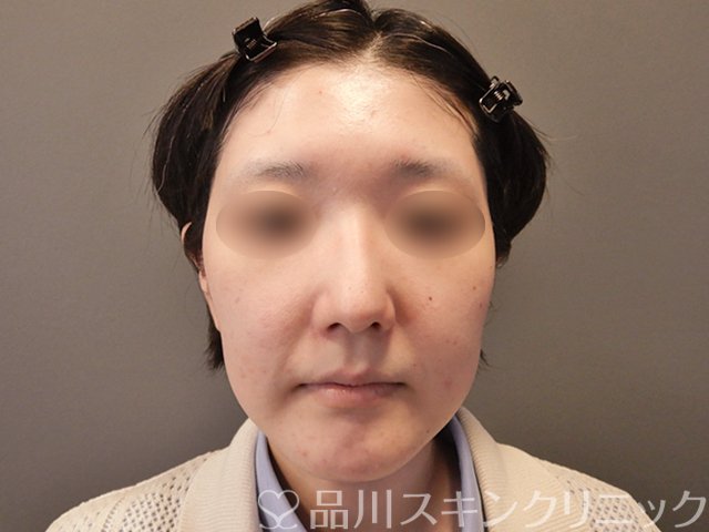 症例NO.65570のAFTER写真