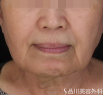 症例NO.71030のBEFORE写真
