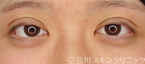 症例NO.58802のAFTER写真