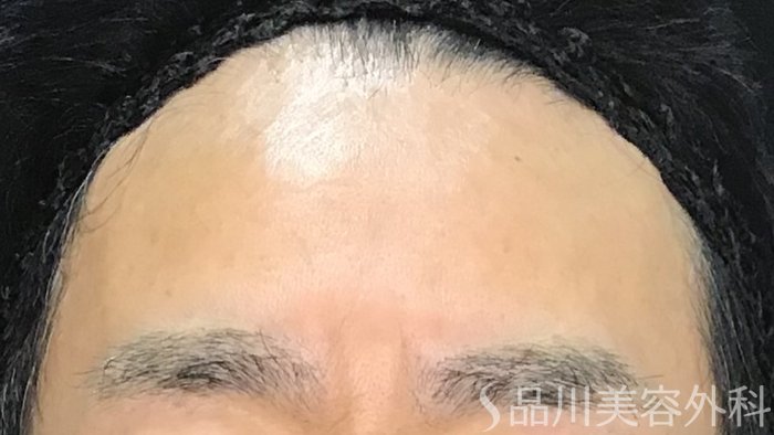 症例NO.70538のAFTER写真