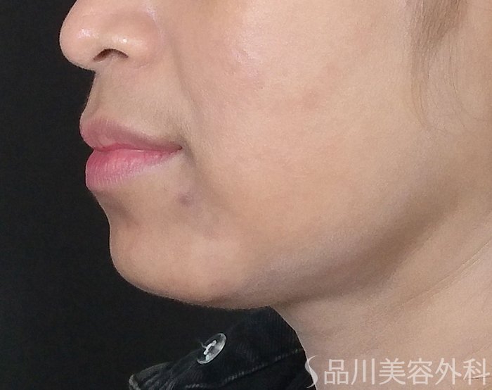 症例NO.69609のBEFORE写真