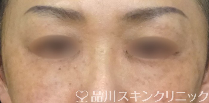 症例NO.69446のAFTER写真