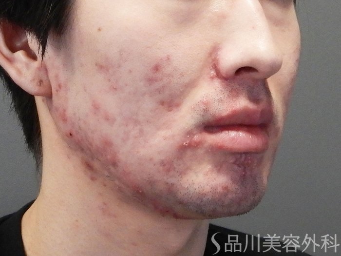 症例NO.72298のBEFORE写真