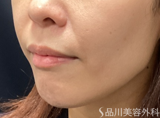 症例NO.74123のBEFORE写真