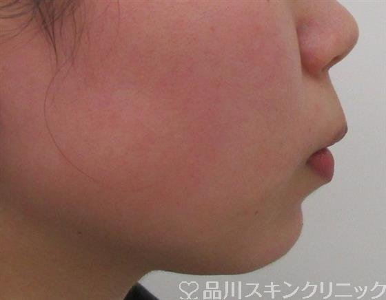 症例NO.40021のAFTER写真