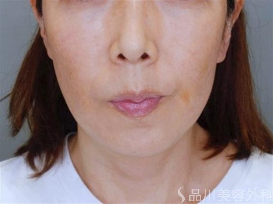 症例NO.51437のBEFORE写真