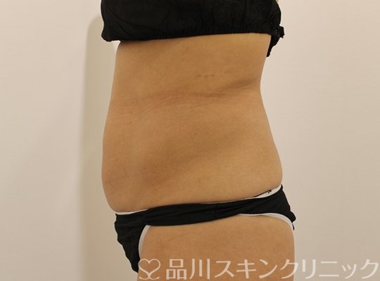 症例NO.74864のAFTER写真
