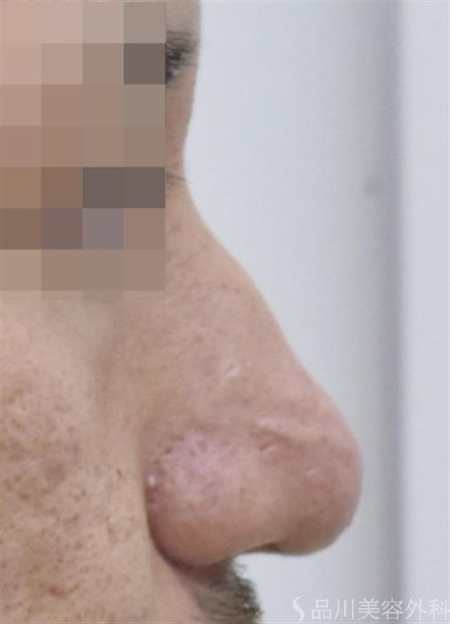 症例NO.48136のAFTER写真