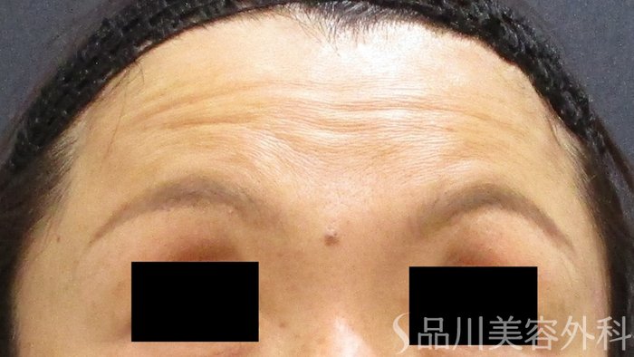 症例NO.65587のBEFORE写真