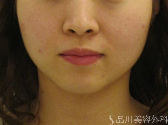 症例NO.43028のBEFORE写真